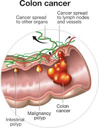 Tumorile de colon drept și tumorile de colon stâng